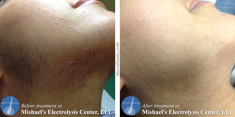 Before & After Electrolysis Hair Removal | Mishael's ...